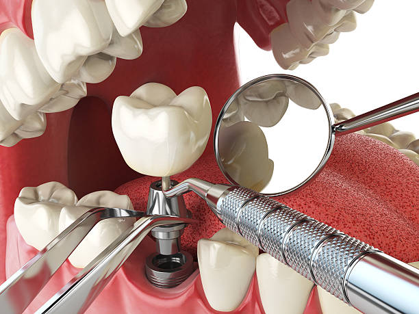 Best Broken or Chipped Tooth Repair in Laurel Hill, VA